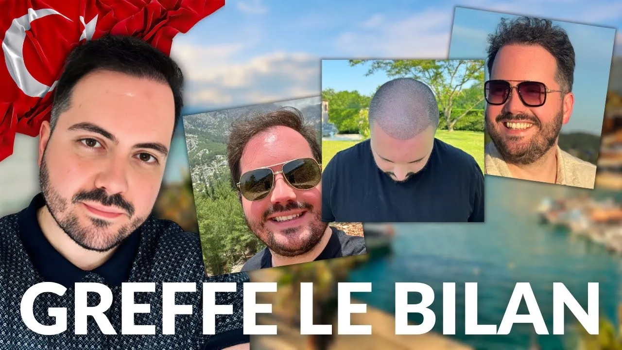 Résultat de la greffe de cheveux après 1 an et demi